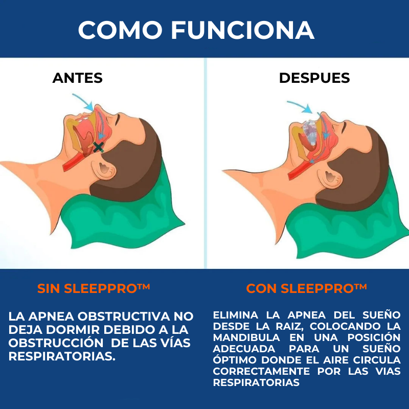SleepPro™ - Protector bucal antironquidos