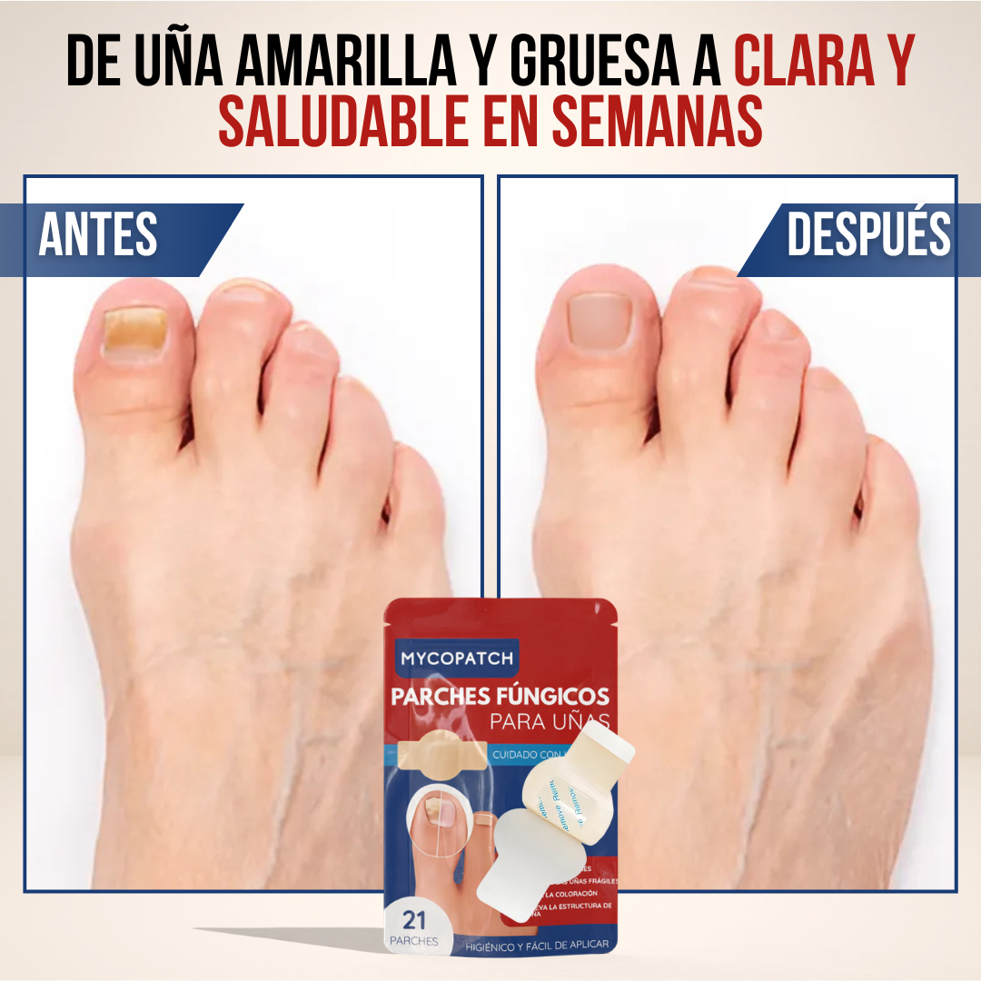 MycoPatch™ - Recupera tus uñas con la fuerza de la ciencia y la naturaleza