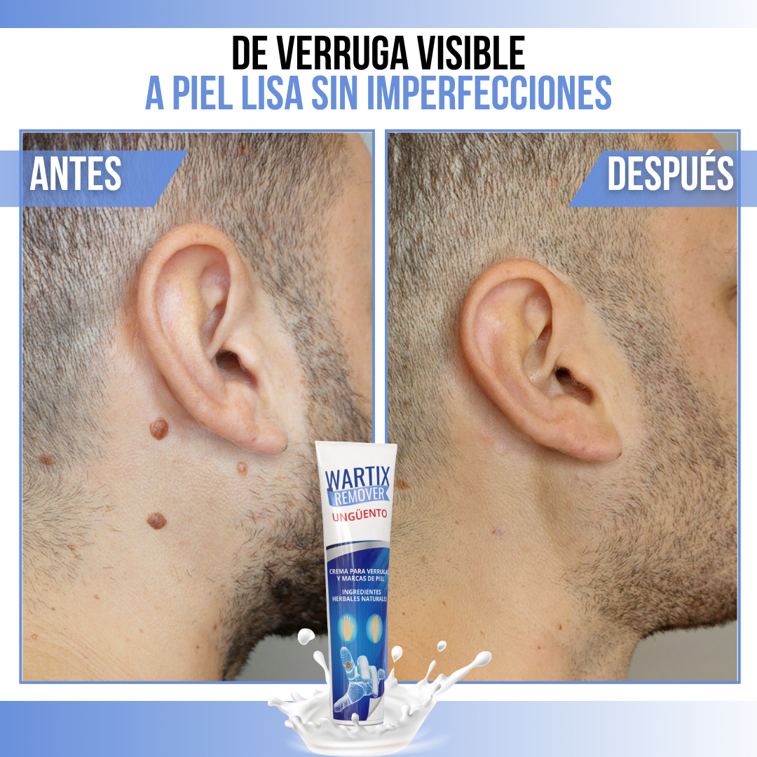 WARTIX REMOVER™ - Piel limpia, libre de verrugas, sin complicaciones