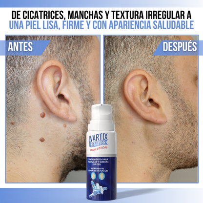 WARTIX REMOVER™ - Elimina verrugas y lunares con suavidad y rapidez