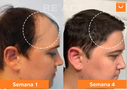 Minoxi™ - tratamiento para el crecimiento del cabello en roll-on