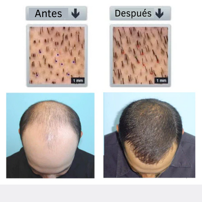 Minoxi™ - tratamiento para el crecimiento del cabello en roll-on